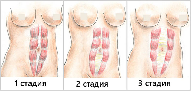 stepeni-diastaza-prjamyh-myshc-zhivota