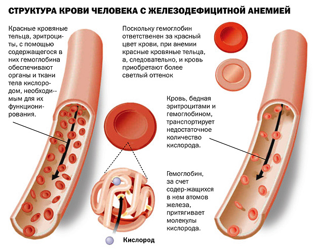 anemiya-pri-beremennosti-simptomy-i-lechenie