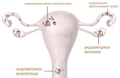 endometrioz-simptomy-i-metody-lecheniya