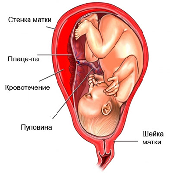 otsloyka-platsenty