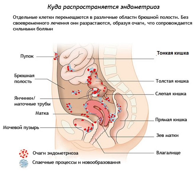 mesta-rasprostranenia-endometrioza-moe1.ru